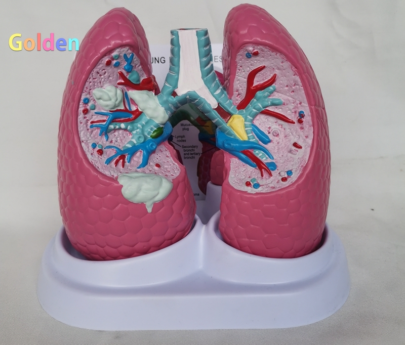 인간 폐 병리학 적 해부학 디스플레이 모델 내장 구조 데모 의료 교육 의사-환자 설명 도구